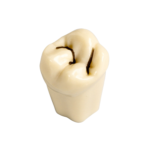 Dientes con caries ANA-4